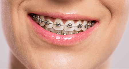 Chirurgie orthodontique