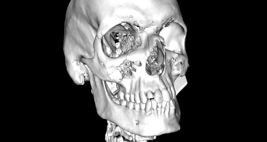 Radiologie 3D Maxillo-faciale